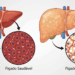 5 maneiras de proteger o fígado e reduzir o risco de esteatose hepática