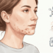 Por que surge acne na fase adulta e como preveni-la e tratá-la?