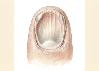 Os sintomas de anemia crônica manifestam-se nas unhas