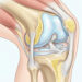 Dor no joelho ao levantar pode indicar desgaste da cartilagem