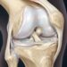 Osteoartrite: um simples hábito matinal pode ajudar a retardar sua progressão