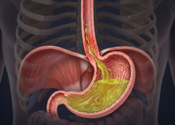 Refluxo gastroesofágico: por que acontece e o que pode ser feito para aliviá-lo