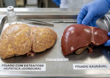 Fígado gorduroso: estratégias naturais mais eficazes para reduzi-lo e melhorar a saúde em casa