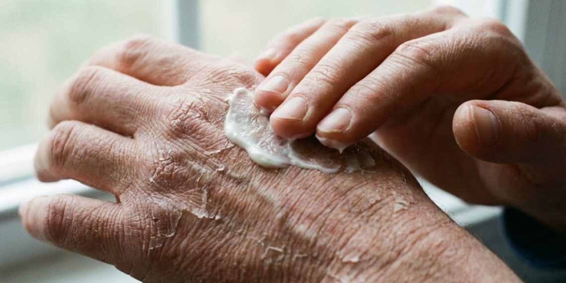 Coceira e pele seca podem ser sinais silenciosos dos rins