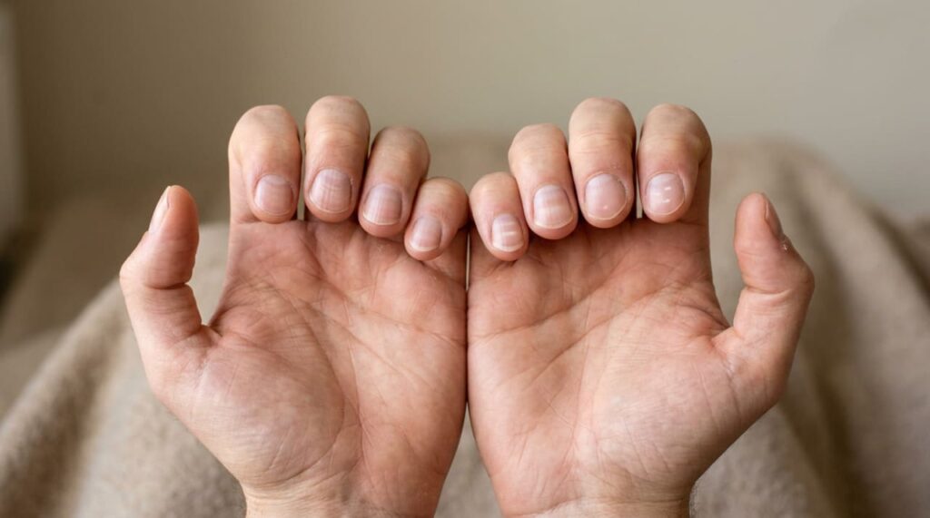 Os sintomas de problemas no fígado manifestam-se nas palmas das mãos