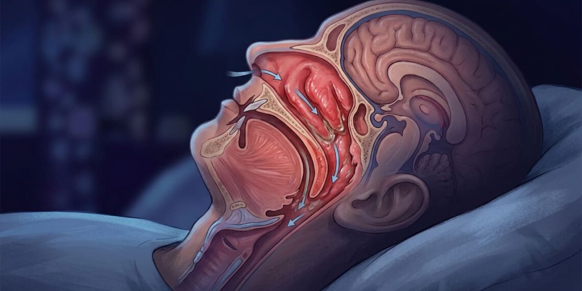 Dorme com o nariz entupido? O médico explica o mecanismo das alergias variáveis e sugere maneiras de melhorar a qualidade de vida