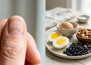 Linhas verticais nas unhas podem indicar falta de vitaminas