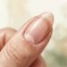 Os sinais de doença podem ser detectados através das unhas