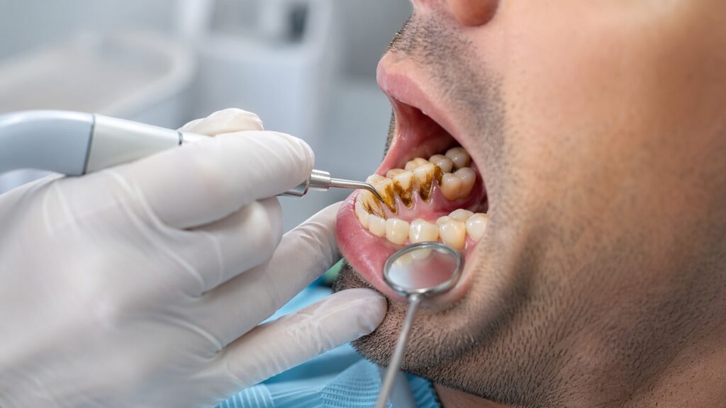 Remoção profissional de tártaro escuro para aliviar a inflamação e proteger a mastigação.