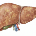 Alterações no fígado podem se manifestar por sinais visíveis como a pele amarelada.