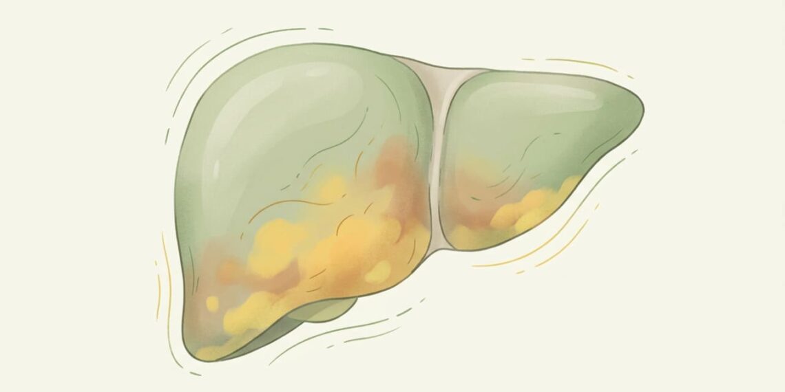 Os hepatologistas apontam os principais sintomas de que o fígado está sobrecarregado antes dos exames alterarem