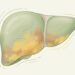Os hepatologistas apontam os principais sintomas de que o fígado está sobrecarregado antes dos exames alterarem