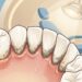 Como tratar o tártaro escuro nos dentes e diminuir o risco de perder nutrientes a curto prazo