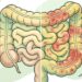 Como é a dor abdominal causada pela síndrome do intestino irritável e como diferenciá-la de uma doença inflamatória intestinal?