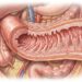 Como reduzir a permeabilidade intestinal e fortalecer a barreira do seu intestino?