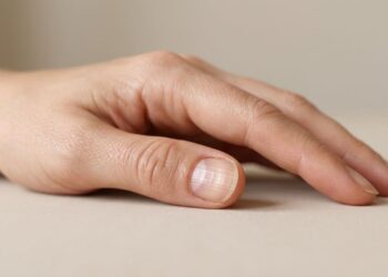 Unhas com linhas verticais: o sinal físico de deficiência nutricional que indica má absorção de vitaminas no intestino