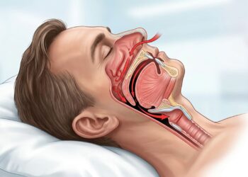 Olheiras profundas e rosto inchado podem ser sinais de apneia do sono
