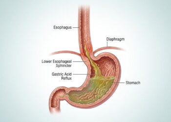 Como reduzir o refluxo ácido e proteger o esôfago de forma natural?