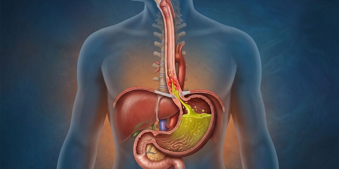Como desinflamar o intestino e reduzir as cólicas frequentes?