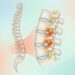 O que é a estenose espinhal: como ela afeta a coluna, sintomas e tratamento