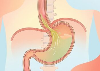 DRGE: o que é, os sintomas mais comuns e como tratar o refluxo gastroesofágico