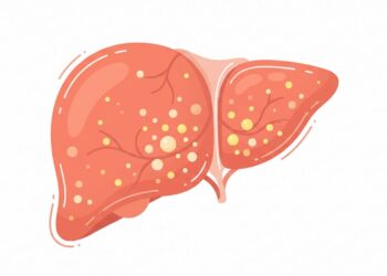 O médico listou cinco sinais precoces de gordura no fígado que aparecem antes dos exames alterarem