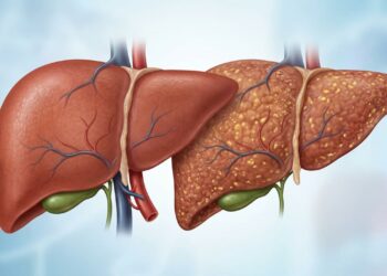 Como saber se tenho fígado gorduroso