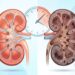 Como a insuficiência renal crônica compromete os rins ao longo do tempo e como ela difere da lesão renal aguda