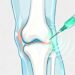 Uma injeção contra a osteoartrite: cientistas descobriram uma nova abordagem para o tratamento