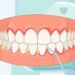 O que pode causar sangramento nas gengivas ao escovar os dentes?