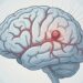 Como é a dor de cabeça causada por aneurisma cerebral em estágio inicial e como diferenciá-la de enxaqueca ou cefaleia tensional