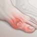 Como é a dor articular causada pela gota em estágio inicial e como diferenciá-la de uma entorse ou fascite plantar