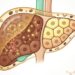 Qual a relação entre a cafeína e a esteatose hepática?