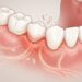 O sangramento na gengiva ao escovar os dentes com frequência é um dos primeiros sinais de que bactérias nocivas podem estar migrando para o cérebro
