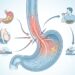 Doença do refluxo gastroesofágico: o que é e como preveni-la sem depender de remédio contínuo?
