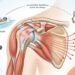 Tendinite no ombro: o que é e como preveni-la em quem pratica musculação ou esportes?