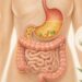 O inchaço abdominal constante e persistente não se deve apenas ao excesso de glúten, mas sim à baixa produção de ácido estomacal e enzimas digestivas