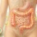 Quais são os sintomas principais da síndrome do intestino permeável e como diferenciá-la de uma intolerância alimentar comum
